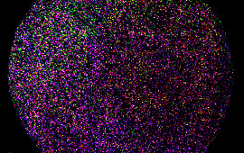 Lymph Node – Anaplastic Large Cell Lymphoma: CD8, FoxP3, CD3, CD4